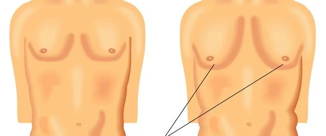 التثدي عند الرجال